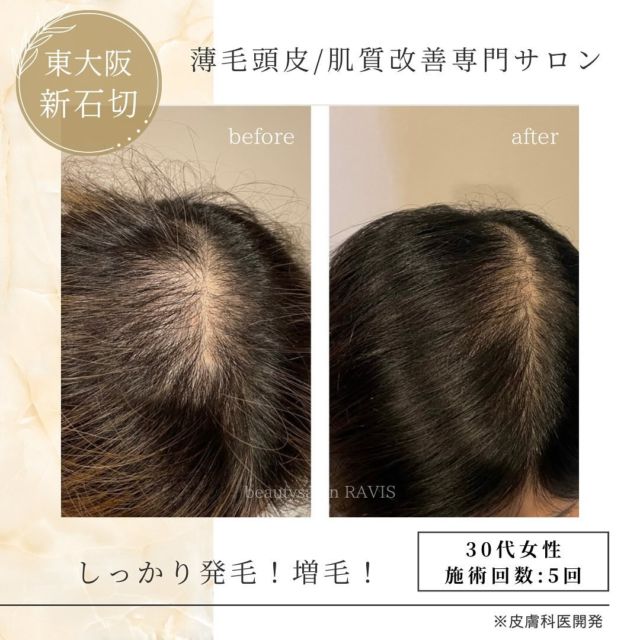 プロセルセラピーズ薄毛のお悩み / 肌質改善 | beautysalon RAVIS 東